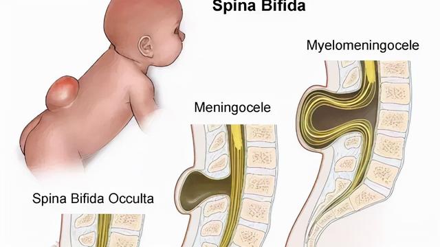 先天性脊髓栓系综合征严重不（新生儿的罕见病）(7)