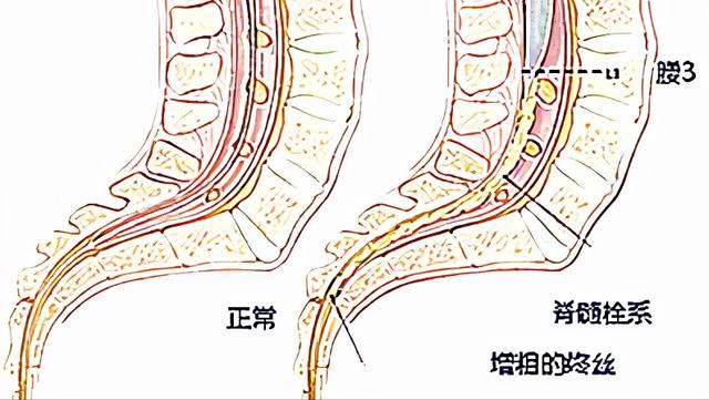 先天性脊髓栓系综合征严重不（新生儿的罕见病）(2)